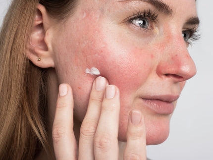 April is Rosacea Awareness Month