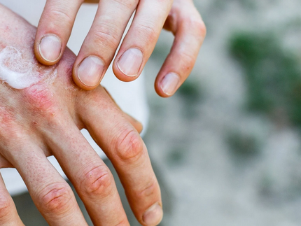 Last van droge handen in de winter? Dit kun je doen