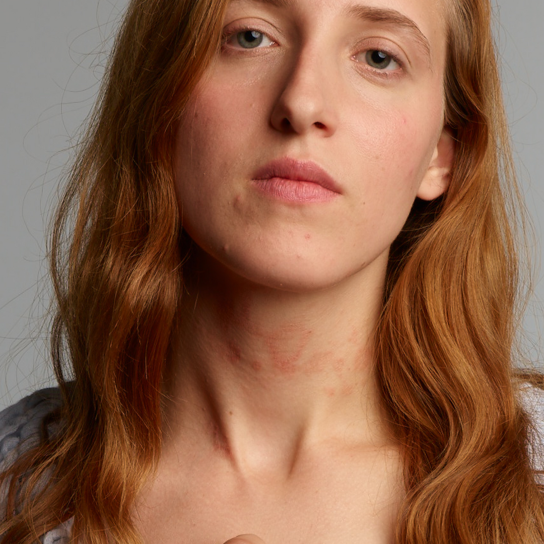 Een vrouw met een gevoelige huid, zichtbare rode plekken in de nek