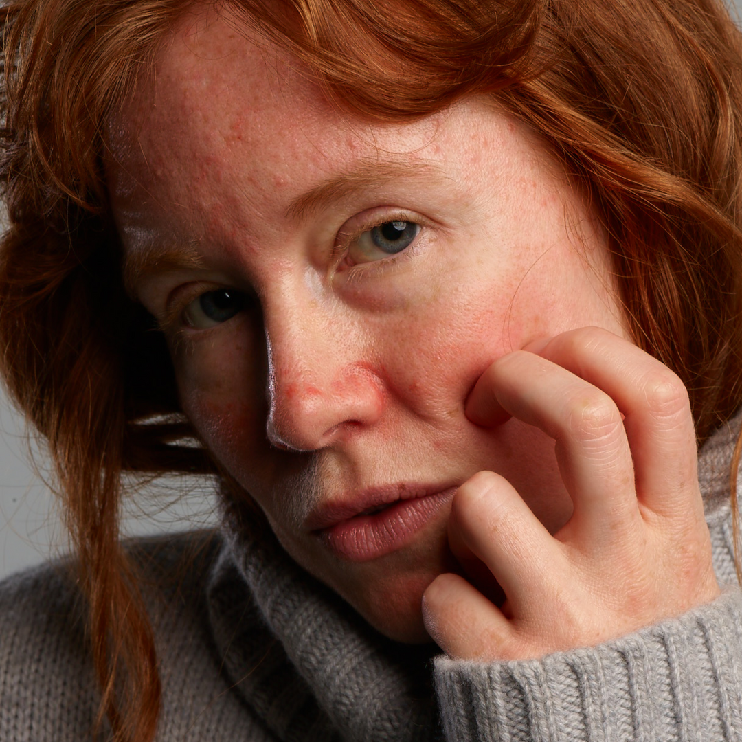 Een vrouw heeft last van roodheid en jeuk in het gezicht.