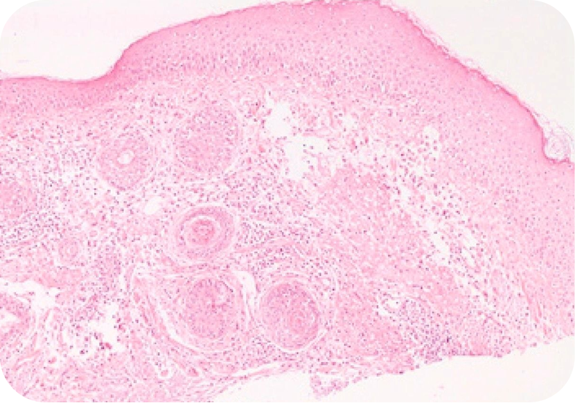 Rosacea: symptomen, triggers en behandelingen