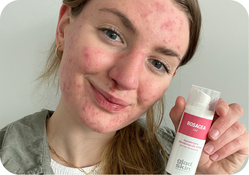Mina deelt haar ervaring met acne en rosacea