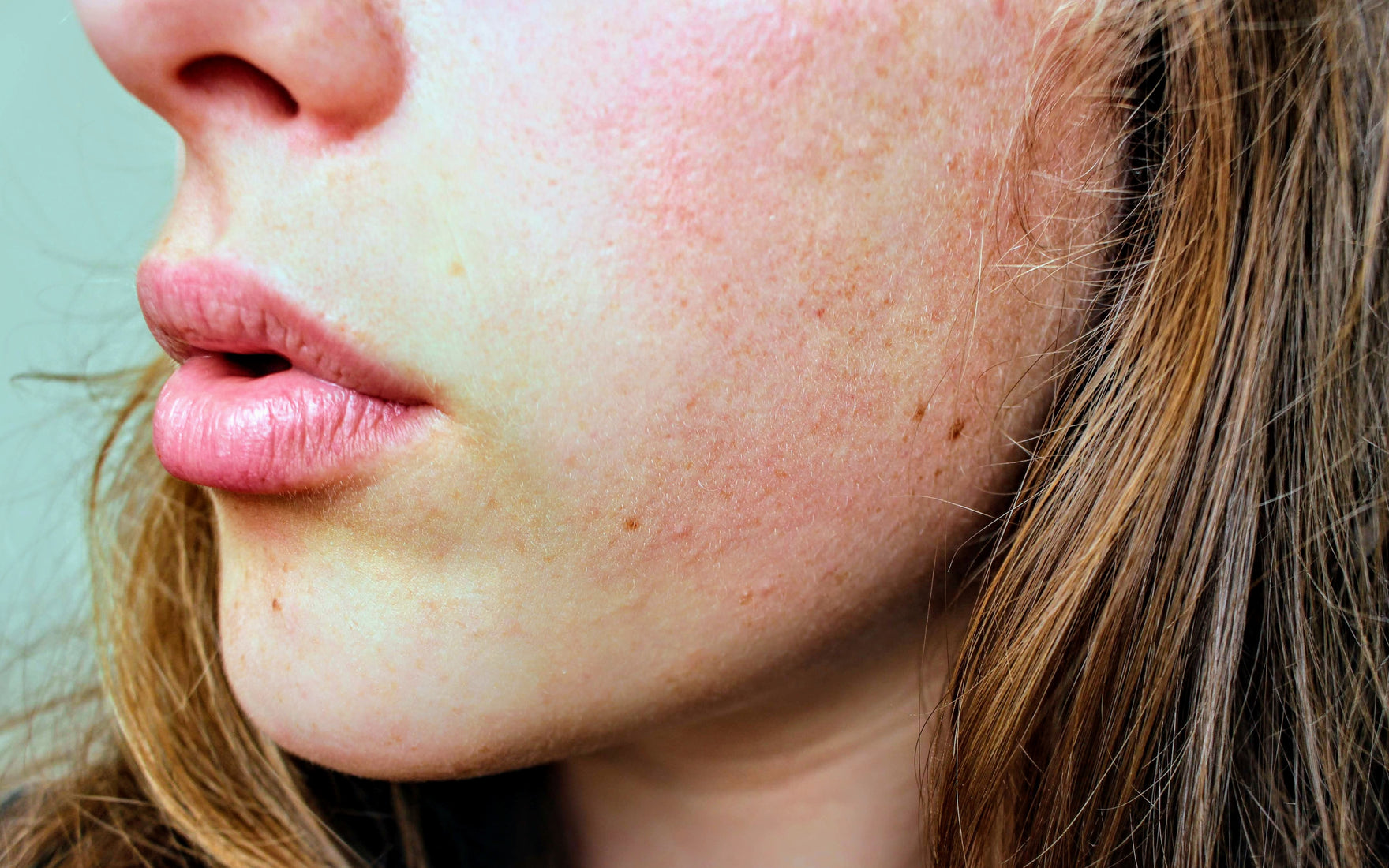Wat is rosacea eigenlijk?