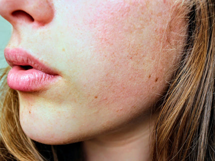 Wat is rosacea eigenlijk?