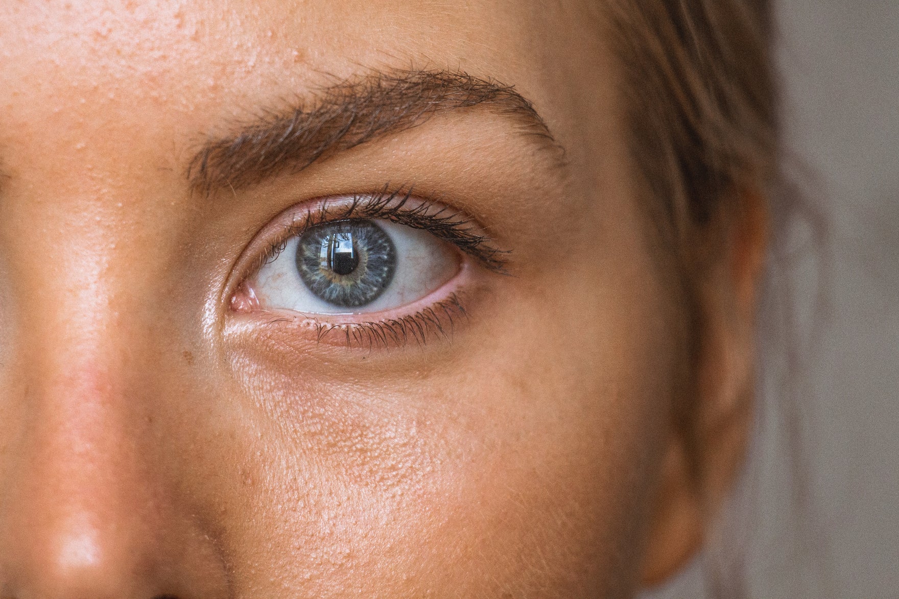 Acne littekens voorkomen en verminderen