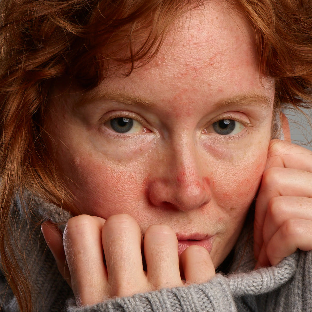 Een vrouw met roodheid en irritatie in het gezicht verbergt zich achter haar kraag.
