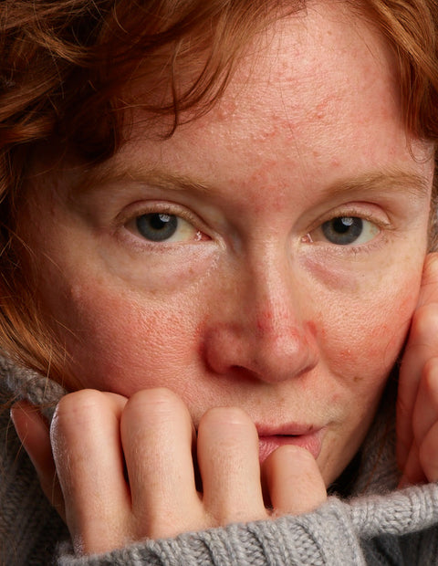 Verminder puistjes en roodheid met de rosacea dag en nacht set
