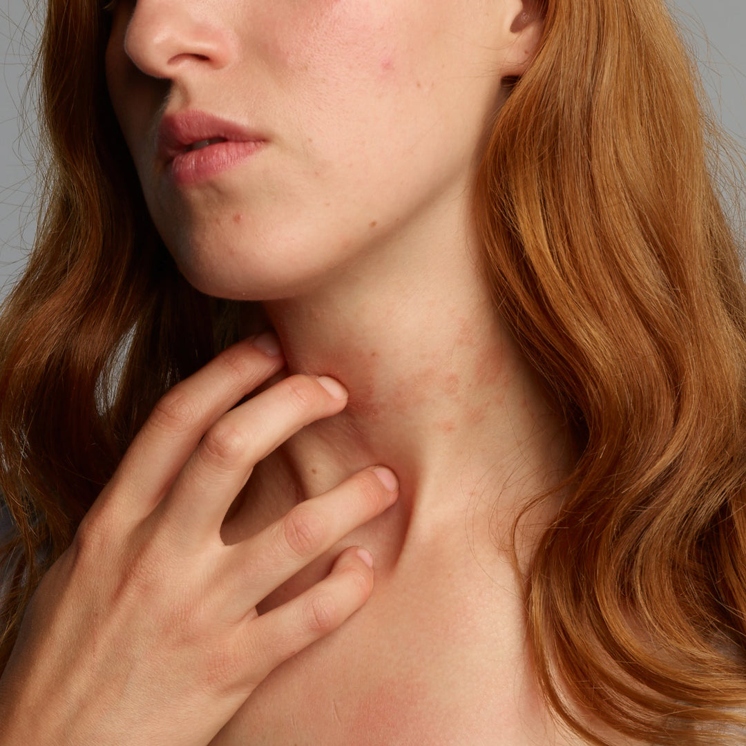 Foto van een vrouw met roodheid in de nek