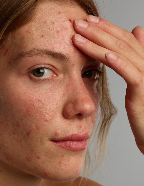 ACNEFEKT Cleansing Set Plus, huidverzorgingsset voor de acnegevoelige huid die voorziet in de specifieke behoeften van reiniging en behandeling van acne symptomen