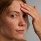 Een vrouw met last van acne smeert Gladskin op haar voorhoofd