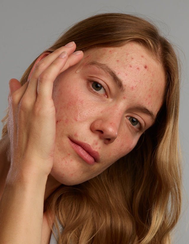 Verminder roodheid en puistjes en gebruik de face wash als een milde clenaser