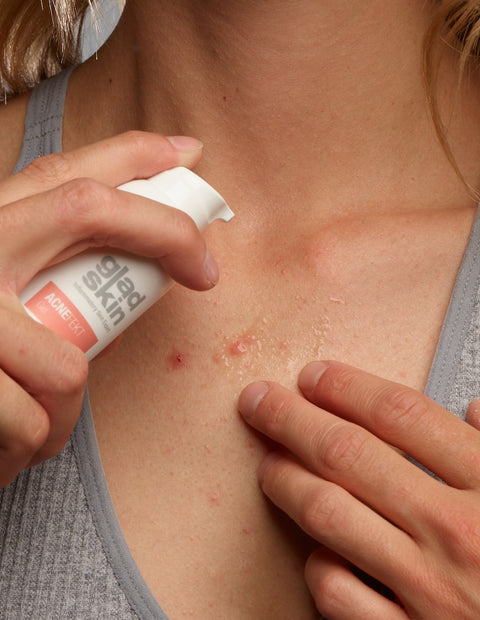 ACNEFEKT Gel is een medisch hulpmiddel dat Staphefekt bevat en ontstekingen vermindert en de zichtbaarheid van puistjes verbetert. 