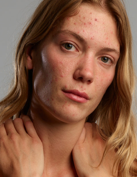 Gladskin Acne Care Set - verminder je acne symptomen