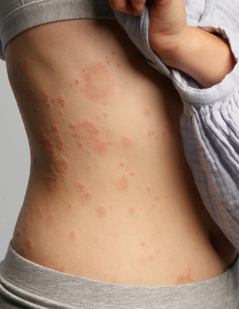 ECZEMACT Care Set, complete oplossing voor het verzachten van eczeemsymptomen en het reinigen van de gevoelige huid