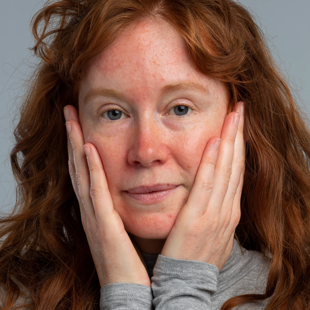 Een vrouw met last van rosacea in het gezicht