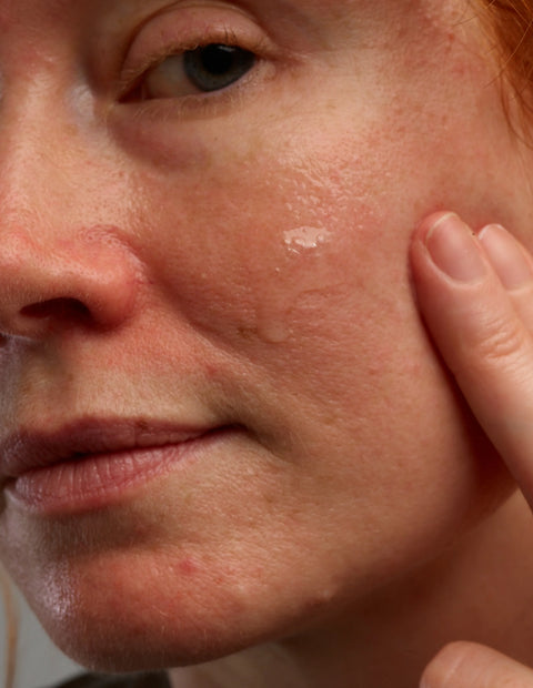 Verminder puistjes en roodheid en verzorg je huid met de moisturizing set