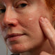 Afbeelding van een vrouw met rosacea en roodheid in het gezicht die Gladskin rosacear gel gebruikt