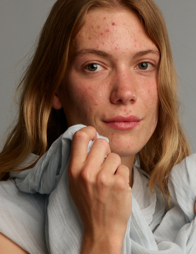 ACNEFEKT Care Set Plus, ideale routine om make-up te verwijderen, de acnehuid te reinigen, te behandelen en te hydrateren