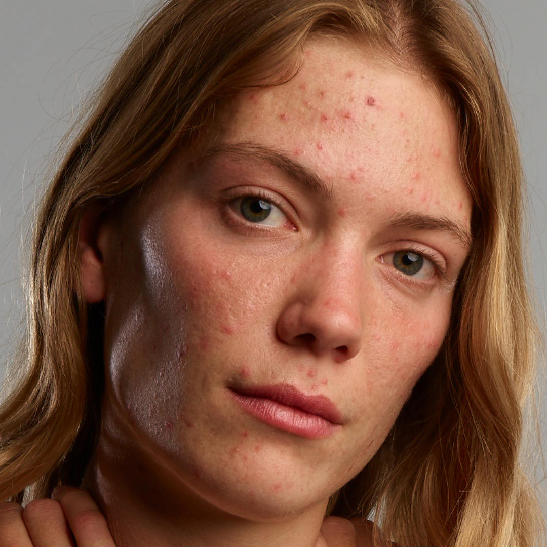 Een close up van een vrouw met last van acne in haar gezicht