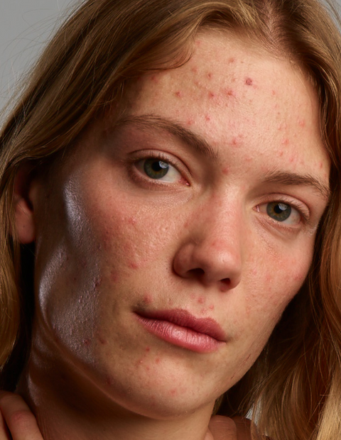 Verminder puistjes en irritaties en hydrateer je huid met de daily care cream