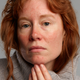 Volwassen vrouw met irritatie en rosacea in het gezicht