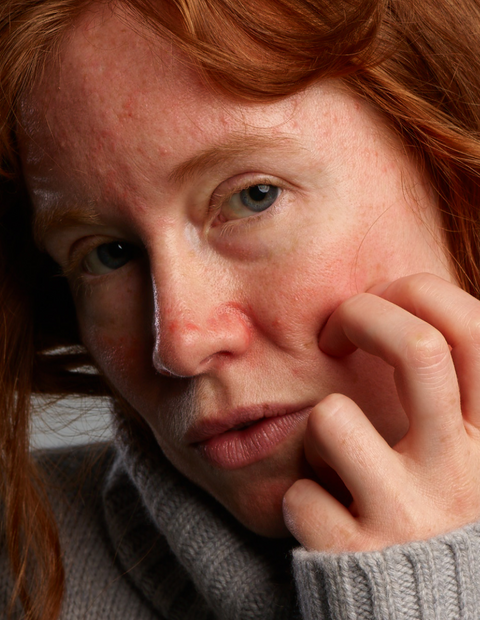 Verminder roodheid en puistjes en gebruik de face wash als een milde clenaser