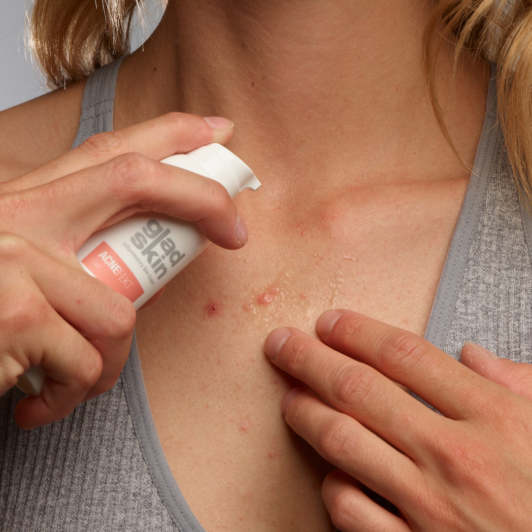 Een vrouw met last van acne in haar decolleté smeert Gladskin op